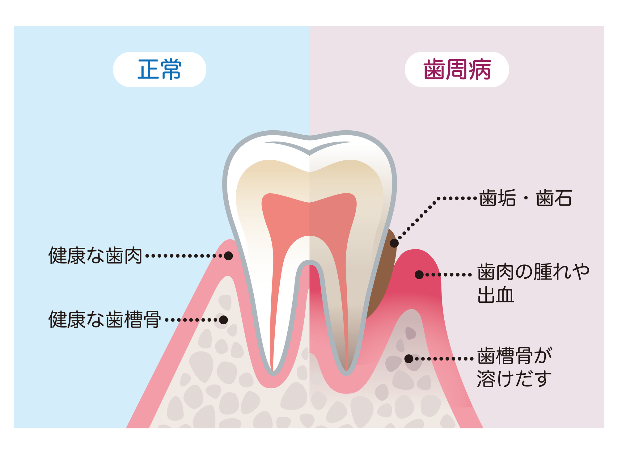 ステージ別歯周病治療