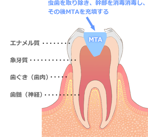 完全に除去して封鎖する